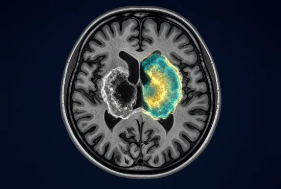 Axial brain MRI with one ring-enhancing lesion split down the middle: bland contrast enhancement on the left and a metabolic glow on the right, illustrating glioblastoma pseudoprogression versus true progression.